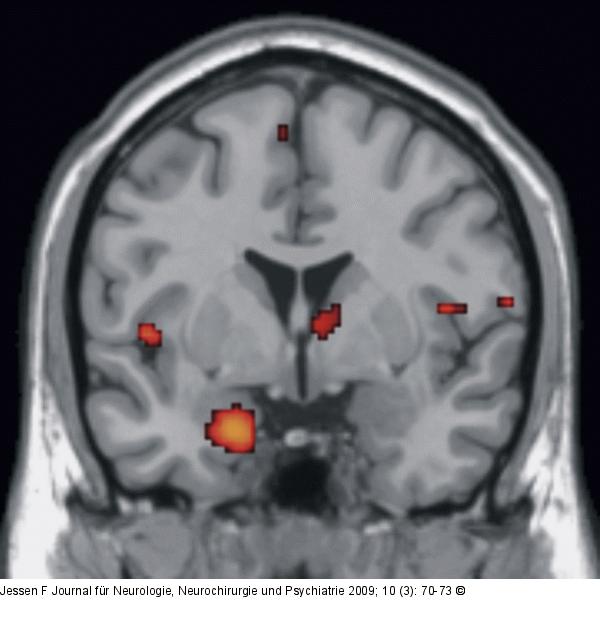 Alzheimer-Demenz