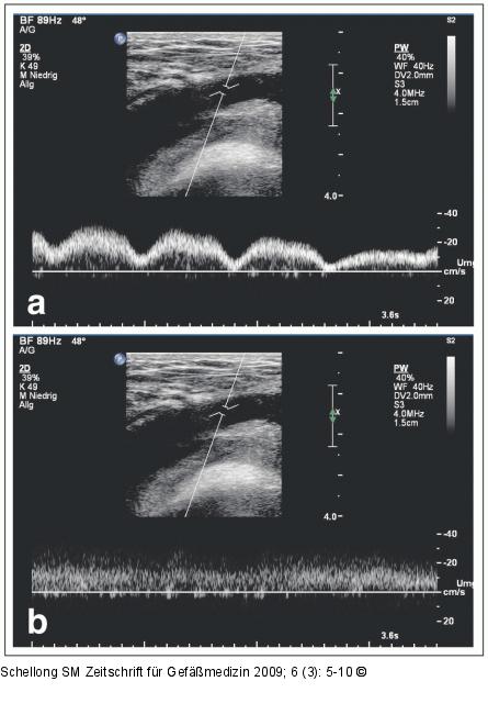 Vena femoralis communis
