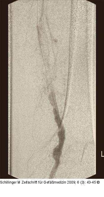 Arteria femoralis - Verschluss