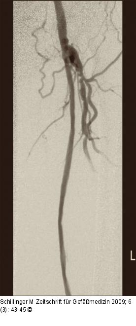 Arteria femoralis - Verschluss 