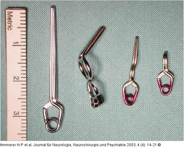 Intrakranielles Aneurysma - Clips