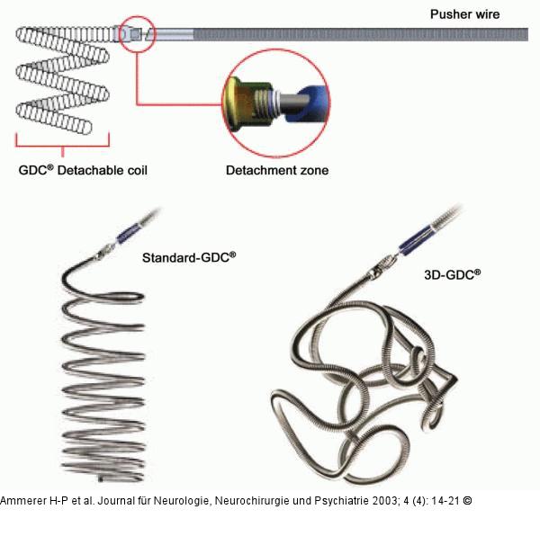 Intrakranielles Aneurysma - Coils