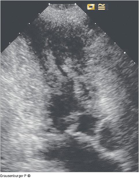 Hypertrophe CMP