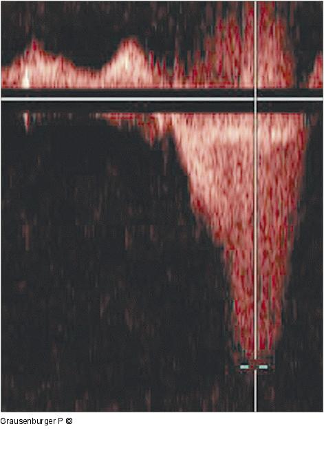 CW-Doppler