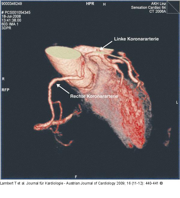 Arteria coronaria
