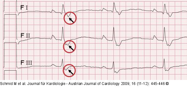 EKG