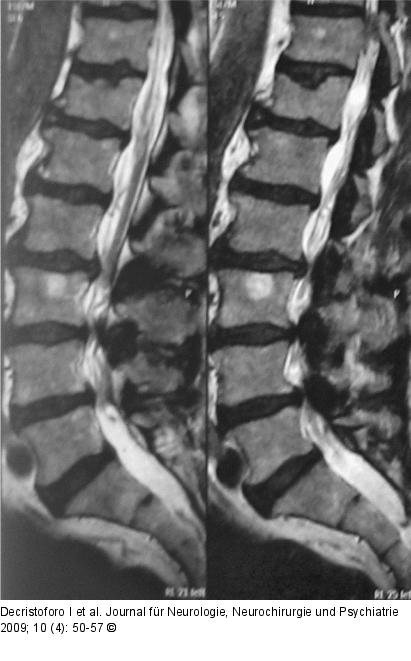 Spinalkanalstenose