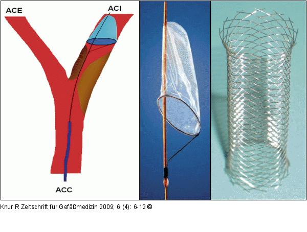 Stentangioplastie