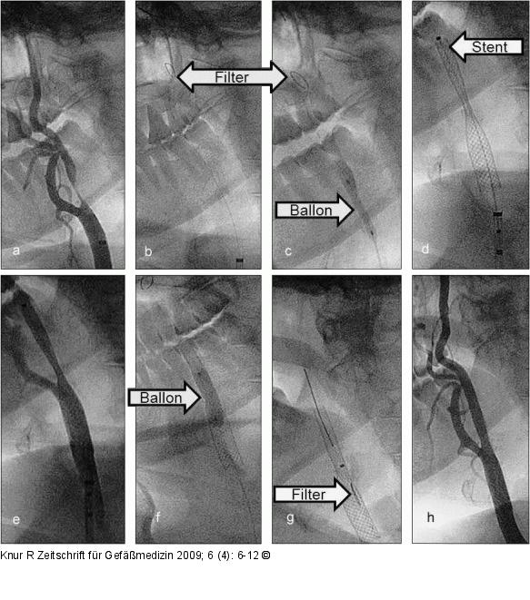Stentangioplastie