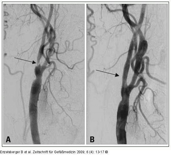 Angiographie