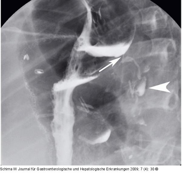 Gastro-bronchiale Fistel