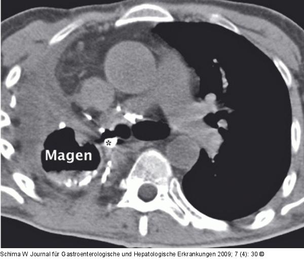 Gastro-bronchiale Fistel