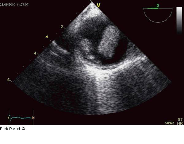 Aorta descendens