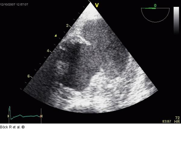 Aorta descendens