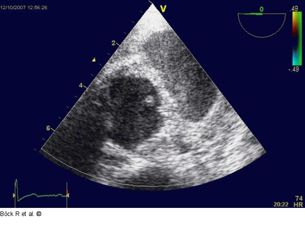 Aorta descendens