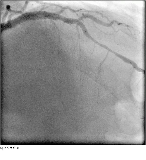 Liberte Stent
