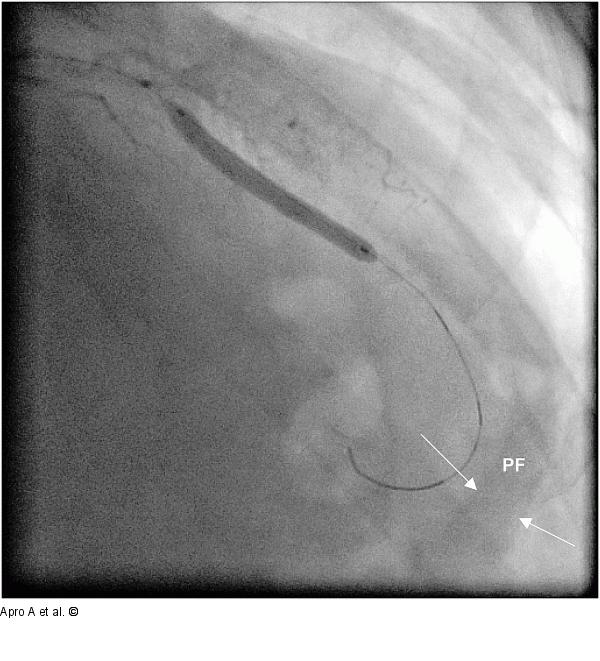 Pericardial fluid