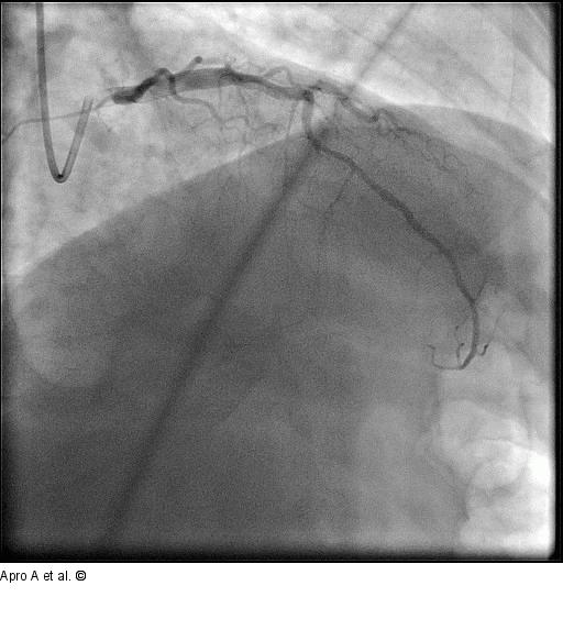Direct Stenting
