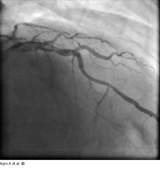 Direct Stenting