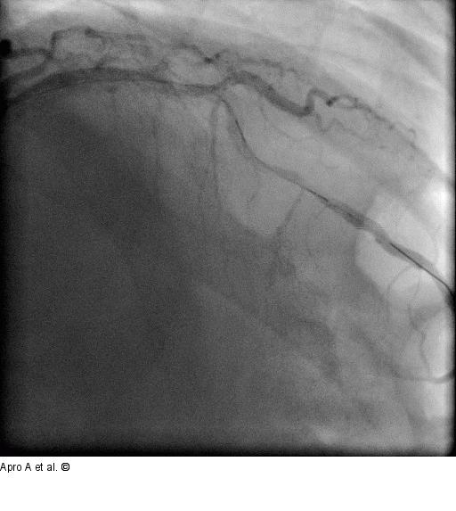 Direct Stenting