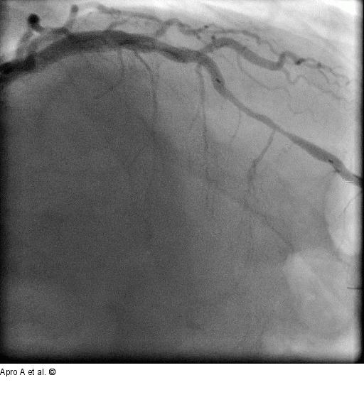 Direct Stenting