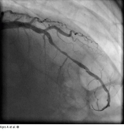Direct Stenting