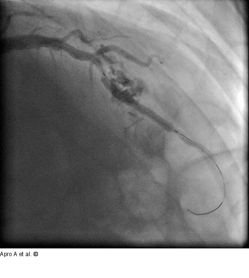 Direct Stenting