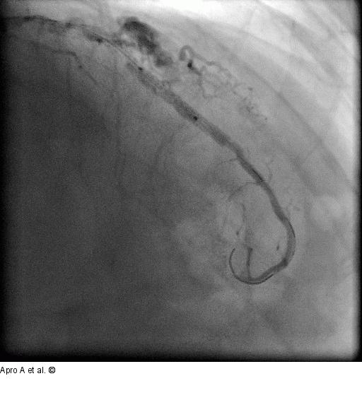 Direct Stenting