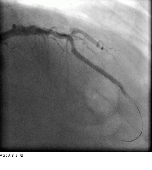 Direct Stenting