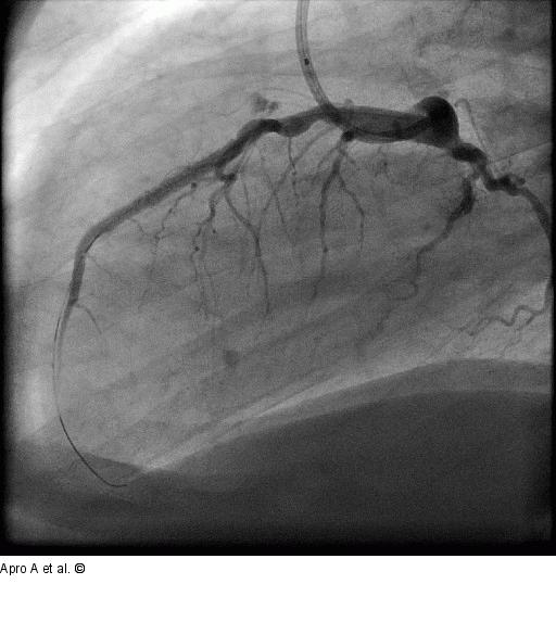 Direct Stenting