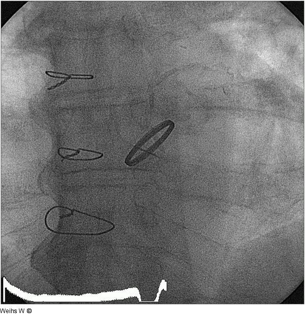 Aortenklappenprothese