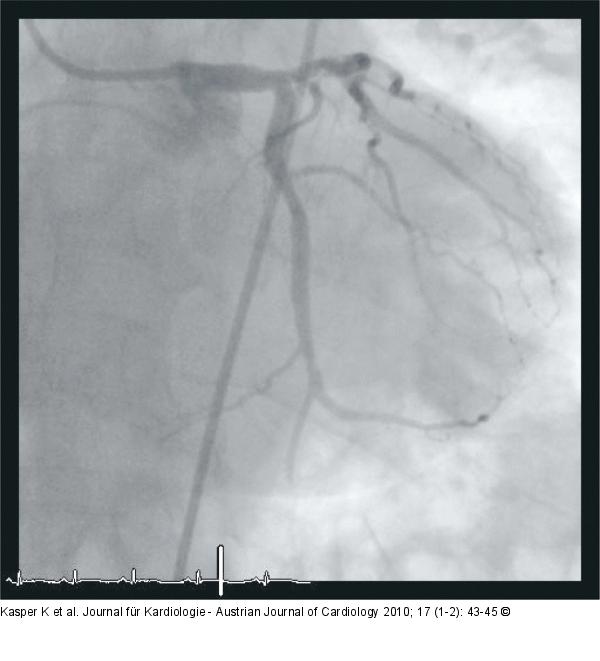 Stent