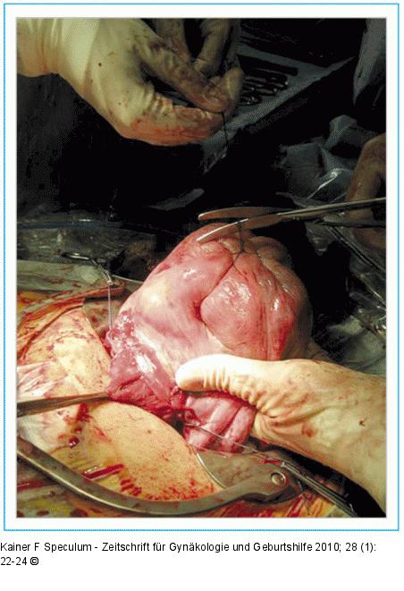 Damage Control Surgery