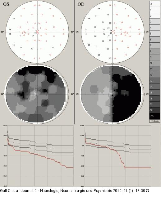Optikusneuritis
