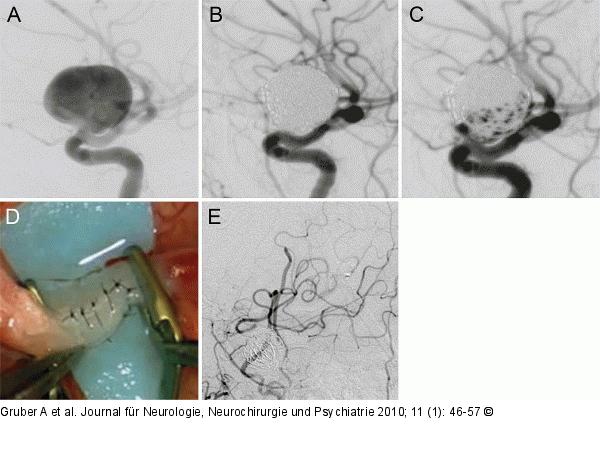 Angiogramme