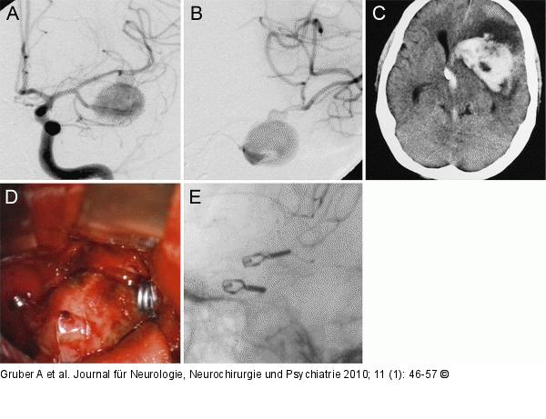 Angiogramme
