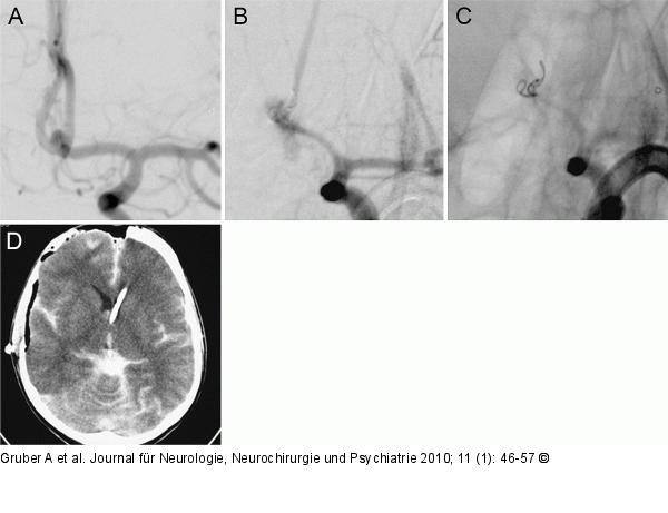 Angiogramme