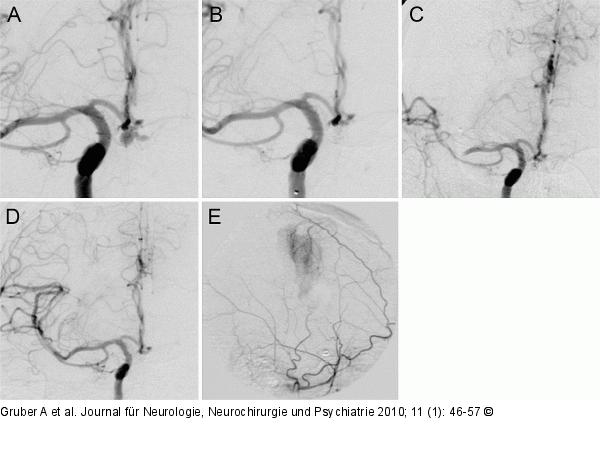Angiogramme