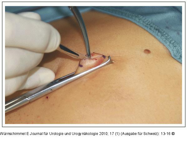 Single-Incision Laparoscopic Surgery