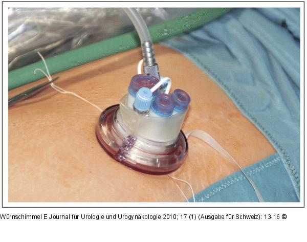 Single-Incision Laparoscopic Surgery