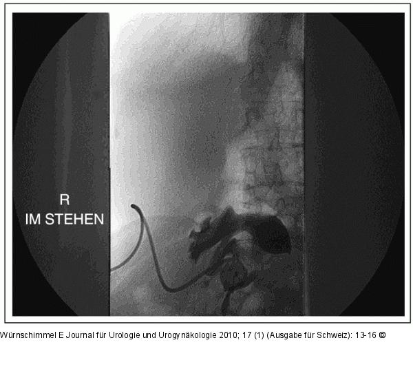Single-Incision Laparoscopic Surgery