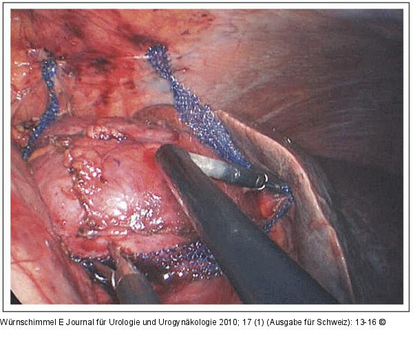 Single-Incision Laparoscopic Surgery
