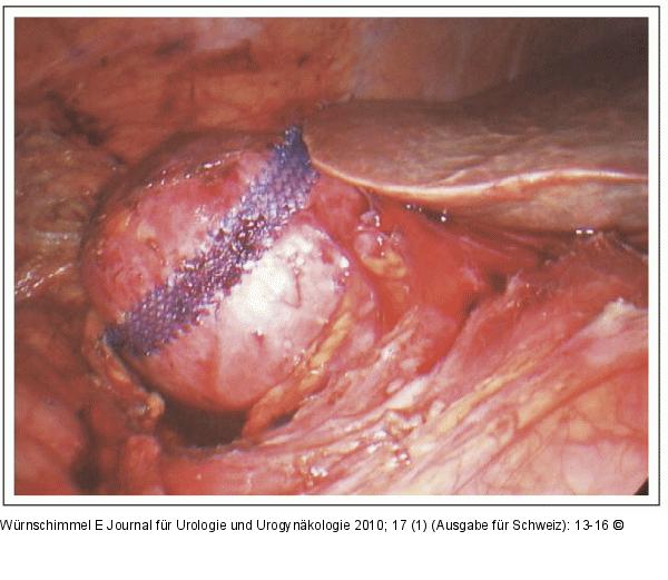 Single-Incision Laparoscopic Surgery