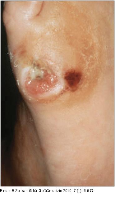 Neurotrophes Ulkus