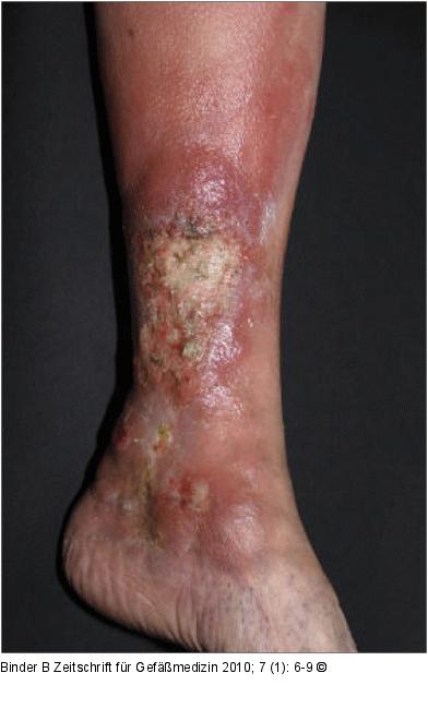 Lymphom