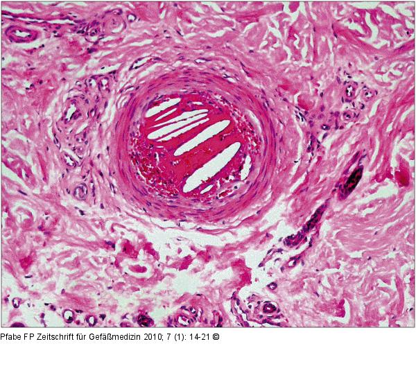 Cholesterinkristallembolie