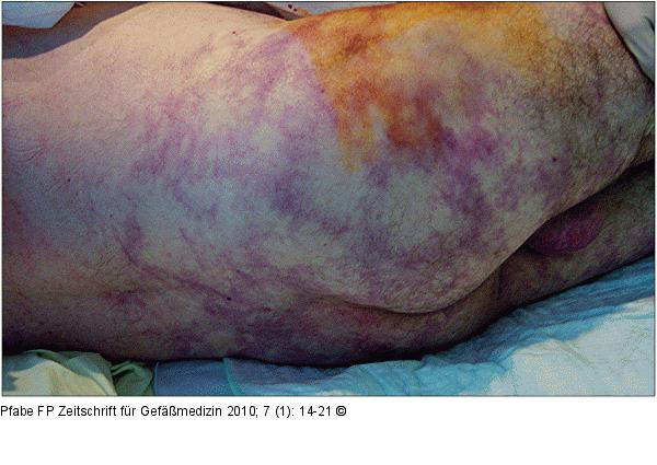 Livedo reticularis