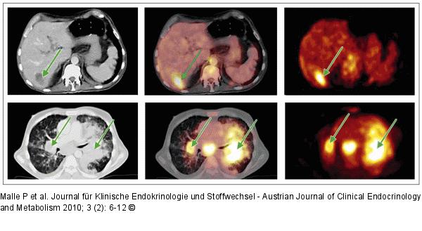 Hepatische Metastase