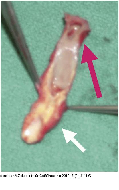 Arteria carotis interna