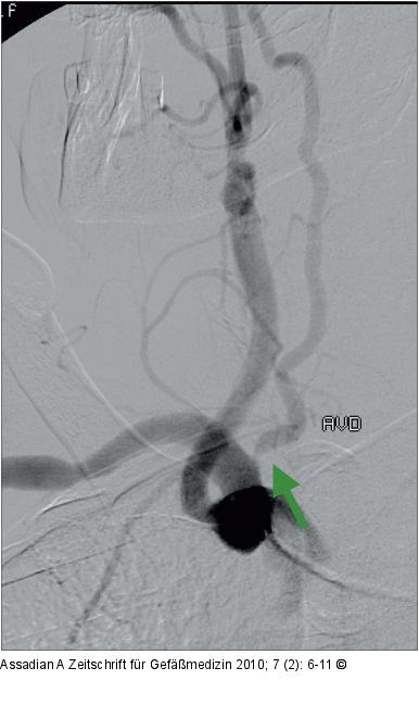 Subtraktionsangiographie